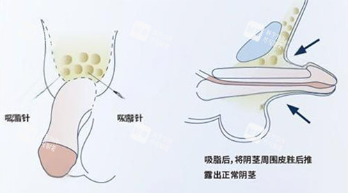吸脂增大阴茎照片