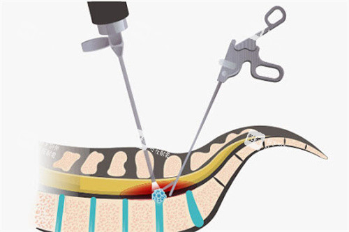 脊椎微创手术