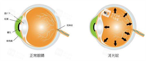 正常眼睛和青光眼
