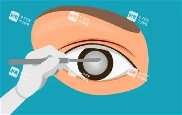 白内障手术治疗卡通图