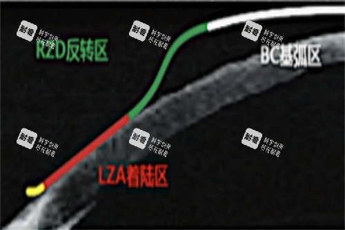 CRT角膜塑形镜作用示意图