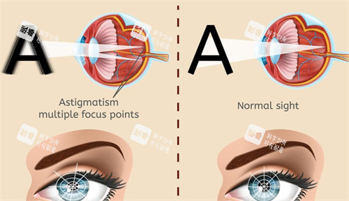 眼球震颤与正常眼睛视物的区别
