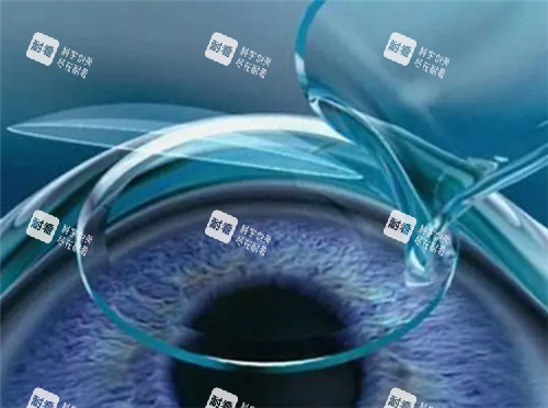 激光近视眼手术细节图 激光近视眼手术细节图