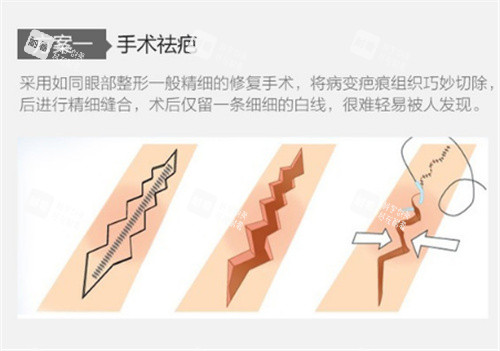 手术祛疤原理图 手术祛疤原理图