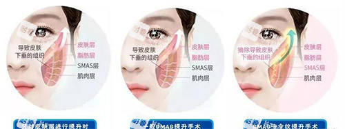 三类拉皮手术方法对比
