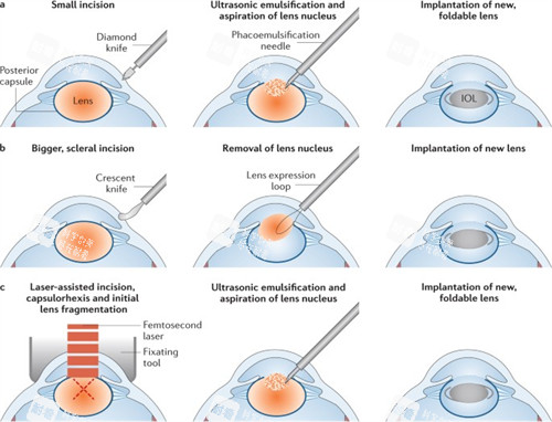 超声乳化白内障手术的流程图
