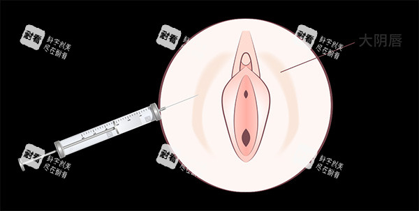 私密阴唇注射照片 私密阴唇注射照片