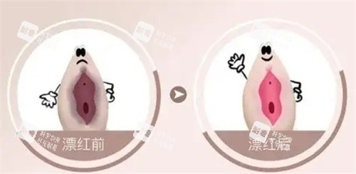 私密漂红/粉嫩术是智商税吗？在线问价格和恢复周期，让你从容做自己。