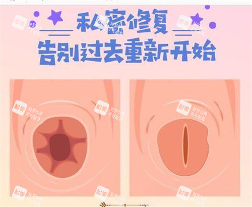 处女膜修复前后对比图