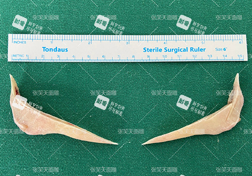 北京圣嘉新医疗美容医院张笑天下颌角手术切骨 北京圣嘉新医疗美容医院张笑天下颌角手术切骨