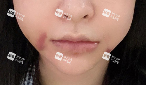 轮廓手术面部肿胀 轮廓手术面部肿胀