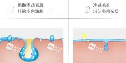 果酸焕肤步骤示意图 果酸焕肤步骤示意图