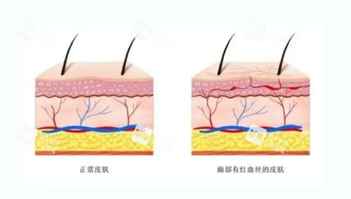 红血丝的皮肤和正常皮肤的对比 红血丝的皮肤和正常皮肤的对比