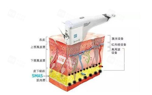激光祛红血丝示意图 激光祛红血丝示意图