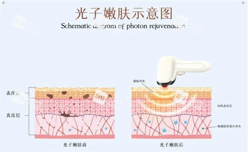 光子嫩肤 光子嫩肤