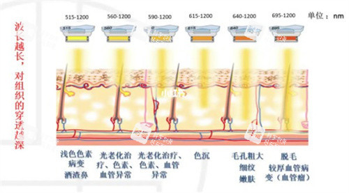 M22光子嫩肤不同波长 M22光子嫩肤不同波长
