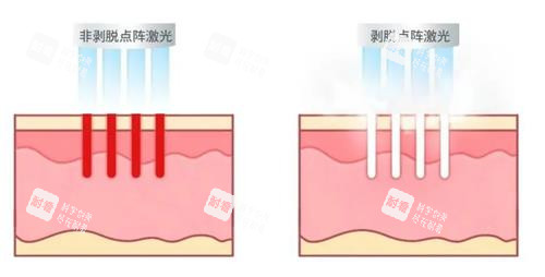 不同类型的点阵激光