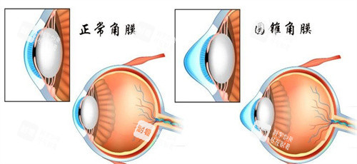 正常角膜和圆锥角膜