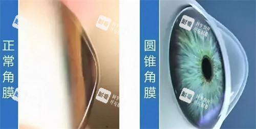 圆锥角膜和正常角膜