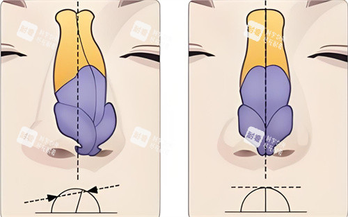 歪鼻矫正术对比图 歪鼻矫正术对比图