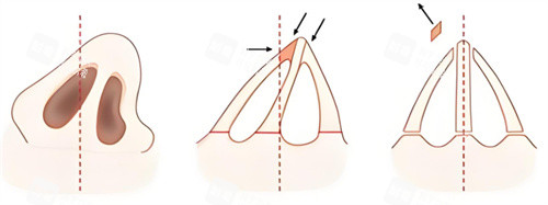 歪鼻矫正术图示 歪鼻矫正术图示