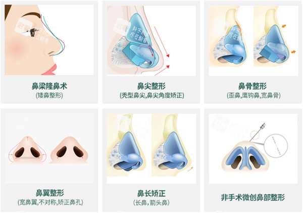 隆鼻手术方法