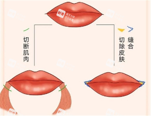 微笑唇整形动画示意图