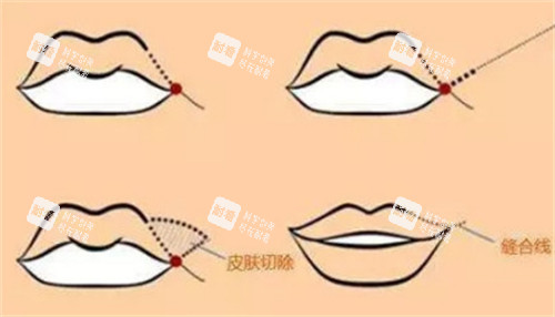 微笑唇手术过程图解