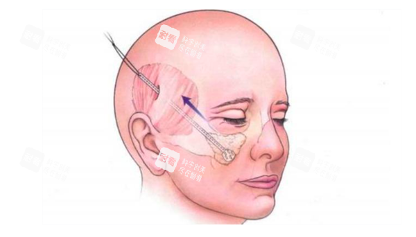 面部拉皮手术展示图 面部拉皮手术展示图