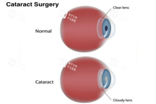 带爸妈在青岛做白内障手术花多少钱？真实账单+流程+术后注意事项，全程经验无保留