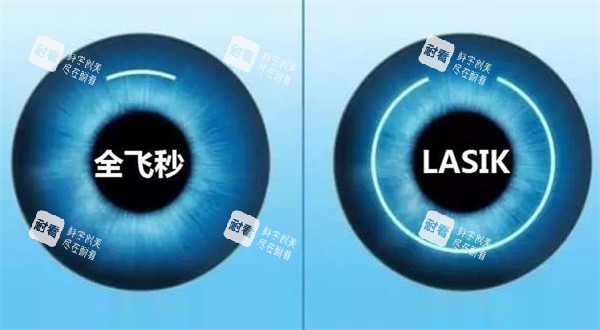 全飞秒激光近视眼手术