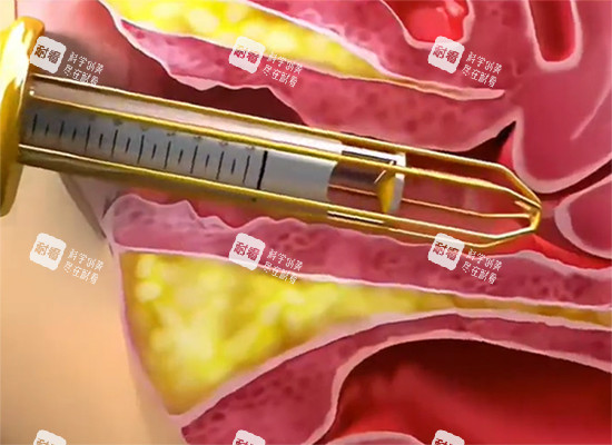 紧缩针过程示意图