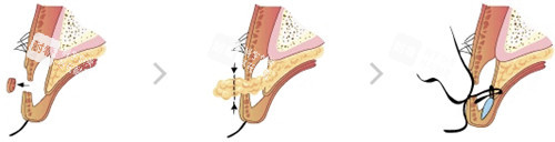 韩国bio整形眼部手术细节展示图 韩国bio整形眼部手术细节展示图