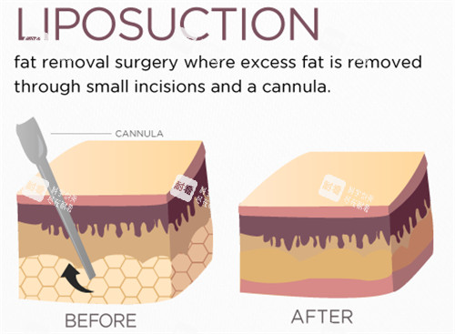 吸脂手术前后动画对比 吸脂手术前后动画对比