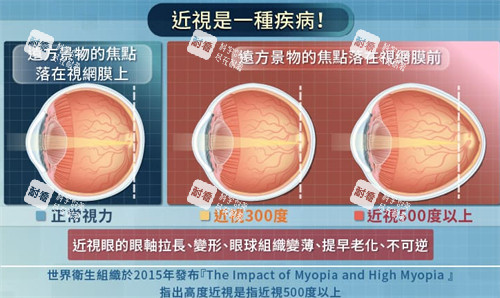 不同程度近视的眼球变化图解