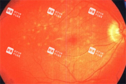 眼底黄斑 眼底黄斑