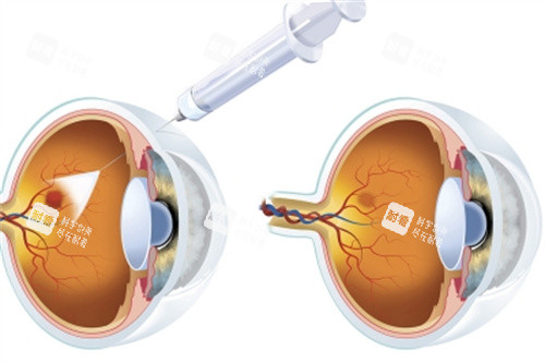 眼底黄斑针 眼底黄斑针