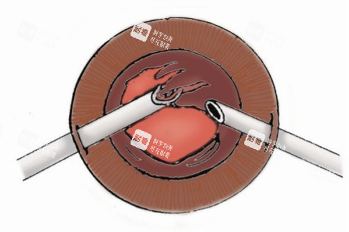 玻璃体切割卡通图 玻璃体切割卡通图