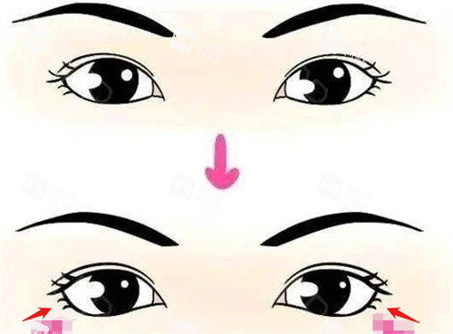 眼睑下至前后对比图.jpg