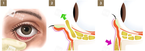 眼袋手术图解