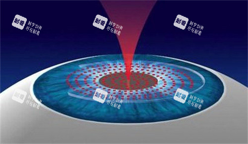 准分子激光手术 准分子激光手术