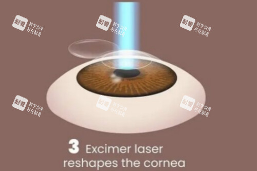 LASEK手术切削基质层 LASEK手术切削基质层