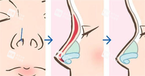 鼻部综合隆鼻术前术后展示图 鼻部综合隆鼻术前术后展示图