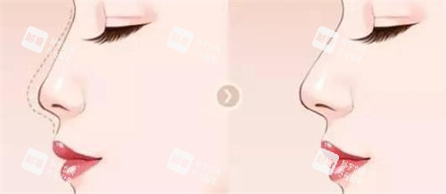 液态隆鼻后的成效 液态隆鼻后的成效