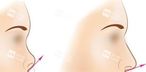 隆鼻手术鼻尖角度调整前后对比图 隆鼻手术鼻尖角度调整前后对比图