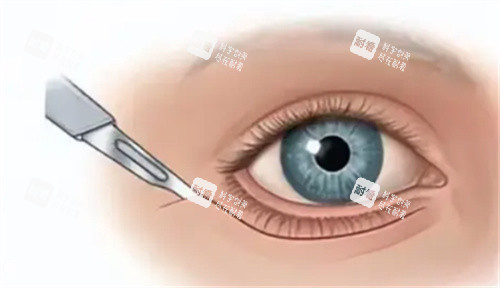 眼周筋膜提升切口