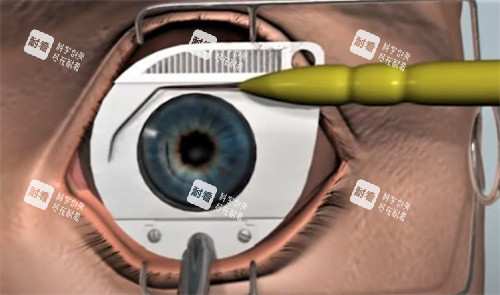 近视手术削角膜