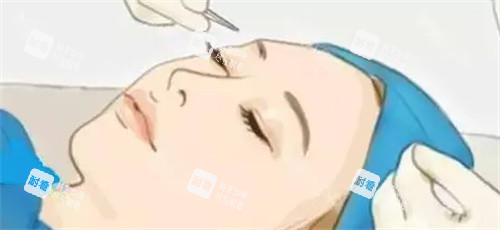 双眼皮手术过程卡通图 双眼皮手术过程卡通图