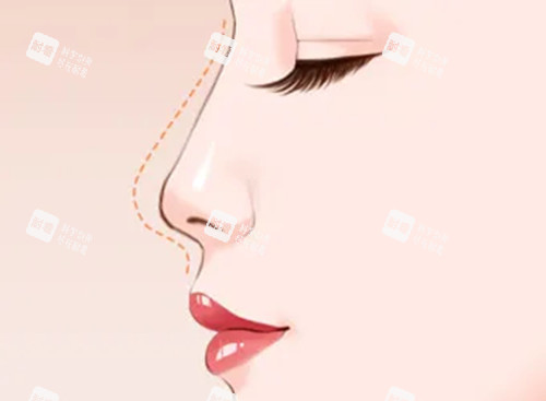 鼻部整形前后对比卡通示意图 鼻部整形前后对比卡通示意图