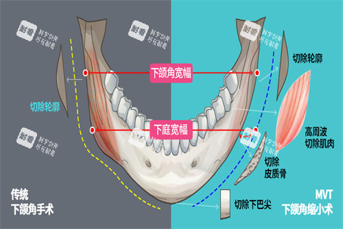 下颌角手术宣传图 下颌角手术宣传图